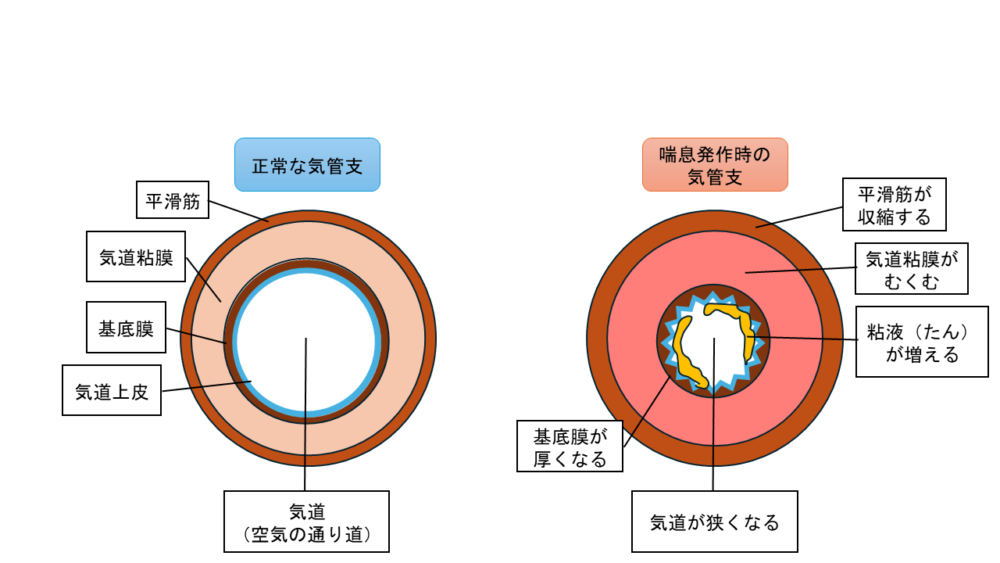 正常な気管支と喘息発作時の気管支
